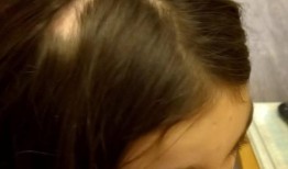 英国11岁小女孩被售票机咬掉头发，秃了一个斑点