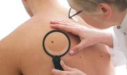 苏格兰足球运动员告诉我们，青少年需要远离太阳的癌症风险