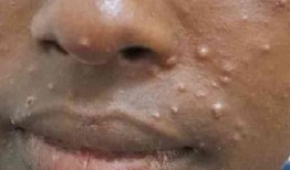 2人死亡10人感染Mpox症状