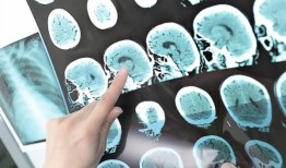 新的指导方针侧重于通过健康的生活方式预防首次中风