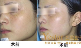 脸上的雀斑怎么去掉,如何去掉脸上的雀斑